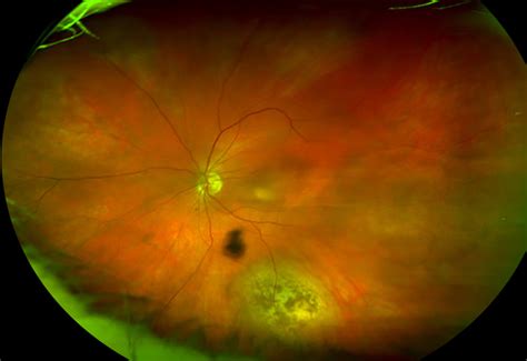West coast retina - A 68 year-old woman presents with a one-year history of blurred central vision in both eyes. Her past ocular history, medical history, family history, social history and medications were non-contributory. On examination, …